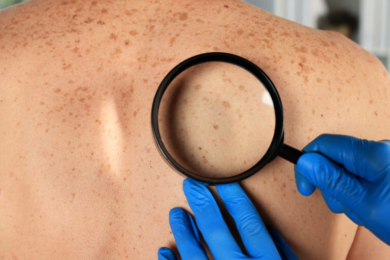 Peptidy na opaľovanie – čo je melanotan, ako pôsobí a čo hovoria výskumy?